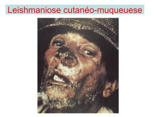 Leishmaniose cutanéo-muqueuese
 
