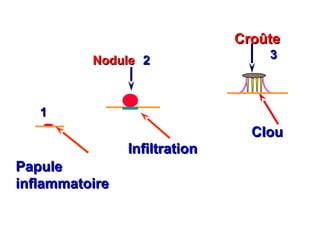 Croûte
          Nodule 2                 3



   1
                                 Clou
                Infiltration
Papule
inflammatoire
 