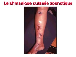Leishmaniose cutanée zoonotique
 
