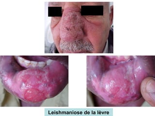 Leishmaniose de la lèvre
 