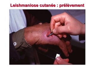 Leishmaniose cutanée : prélèvement
 