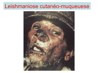 Leishmaniose cutanéo-muqueuese
 