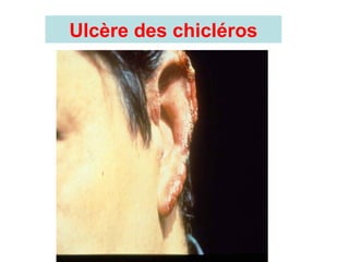 Ulcère des chicléros
 