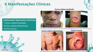 6 Manifestações Clínicas
Leishmaniose Tegumentar Americana
• Forma cutânea localizada
• Forma cutânea disseminada
• Forma mucosa
Forma cutânea localizada
Forma cutânea disseminada Forma mucosa
Fonte: www.googleimagens.com.br Acessado em 30 de junho de 2025.
Fonte: www.googleimagens.com.br Acessado em 30 de junho de 2025.
Fonte: www.ministsaude.com.br Acessado em 30 de junho de 2025. Fonte: www.ministsaude.com.br Acessado em 30 de junho de 2025.
Brasil, 2007.
8
 