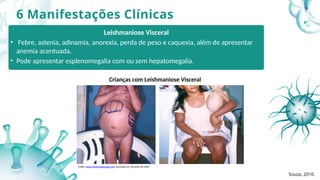6 Manifestações Clínicas
Leishmaniose Visceral
• Febre, astenia, adinamia, anorexia, perda de peso e caquexia, além de apresentar
anemia acentuada.
• Pode apresentar esplenomegalia com ou sem hepatomegalia.
Crianças com Leishmaniose Visceral
Fonte: www.misteriodasaude.com acessado em 30 junho de 2025
Souza, 2010.
9
 