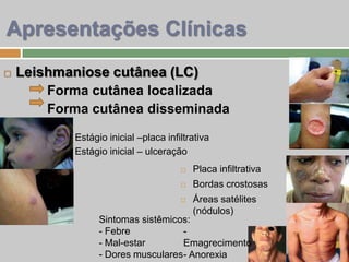  Leishmaniose cutânea (LC)
Forma cutânea localizada
Forma cutânea disseminada
Estágio inicial –placa infiltrativa
Estágio inicial – ulceração
Apresentações Clínicas
 Placa infiltrativa
 Bordas crostosas
 Áreas satélites
(nódulos)
Sintomas sistêmicos:
- Febre
- Mal-estar
- Dores musculares
-
Emagrecimento
- Anorexia
 