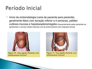    Início da sintomatologia (varia de paciente para paciente),
    geralmente febre com duração inferior a 4 semanas, palidez
    cutâneo-mucosa e hepatoesplenomegalia (frequentemente estes pacientes se
    apresentam o serviço médico fazendo uso de antimicrobiano sem resposta clínica)
 