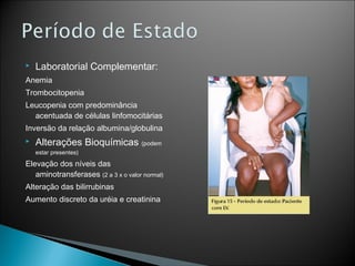    Laboratorial Complementar:
Anemia
Trombocitopenia
Leucopenia com predominância
  acentuada de células linfomocitárias
Inversão da relação albumina/globulina
   Alterações Bioquímicas (podem
    estar presentes)

Elevação dos níveis das
   aminotransferases (2 a 3 x o valor normal)
Alteração das bilirrubinas
Aumento discreto da uréia e creatinina
 