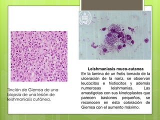 Leishmaniasis muco-cutanea
                           En la lamina de un frotis tomado de la
                           ulceración de la nariz, se observan
                           leucocitos e histiocitos y además
Tinción de Giemsa de una   numerosas       leishmanias.      Las
biopsia de una lesión de   amastigotas con sus kinetoplastos que
leishmaniasis cutánea.     parecen bastones pequeños, se
                           reconocen en esta coloración de
                           Giemsa con el aumento máximo.
 