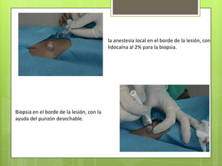 la anestesia local en el borde de la lesión, con
                                           lidocaína al 2% para la biopsia.




Biopsia en el borde de la lesión, con la
ayuda del punzón desechable.
 
