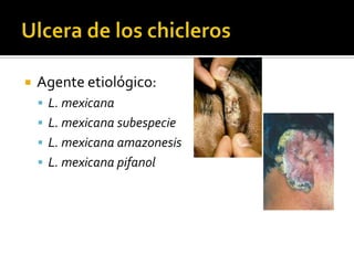 Ulcera de los chiclerosAgente etiológico:L. mexicanaL. mexicana subespecieL. mexicana amazonesisL. mexicana pifanol