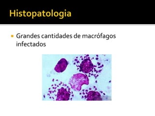 HistopatologiaGrandes cantidades de macrófagos infectados