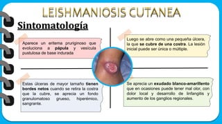 Sintomatología
Aparece un eritema pruriginoso que
evoluciona a pápula y vesícula
pustulosa de base indurada
Luego se abre como una pequeña úlcera,
la que se cubre de una costra. La lesión
inicial puede ser única o múltiple.
Estas úlceras de mayor tamaño tienen
bordes netos cuando se retira la costra
que la cubre, se aprecia un fondo
granulomatoso grueso, hiperémico,
sangrante.
Se aprecia un exudado blanco-amarillento
que en ocasiones puede tener mal olor, con
dolor local y desarrollo de linfangitis y
aumento de los ganglios regionales.
 