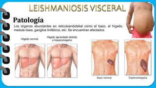 Patología
Los órganos abundantes en reticuloendotelial como el bazo, el hígado,
medula ósea, ganglios linfáticos, etc. Se encuentran afectados.
 