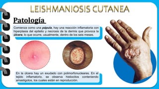 Patología
Comienza como una pápula, hay una reacción inflamatoria con
hiperplasia del epitelio y necrosis de la dermis que provoca la
úlcera, lo que ocurre, usualmente, dentro de los seis meses.
En la úlcera hay un exudado con polimorfonucleares. En el
tejido inflamatorio, se observa histiocitos conteniendo
amastigotos, los cuales están en reproducción.
 