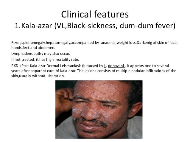 Leismaniasis leismaniasis