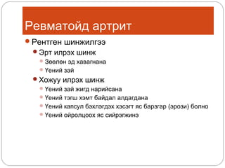 Ревматойд артрит
Рентген шинжилгээ
Эрт илрэх шинж
 Зөөлөн эд хавагнана
 Үений зай
Хожуу илрэх шинж
 Үений зай жигд нарийсана
 Үений тэгш хэмт байдал алдагдана
 Үений капсул бэхлэгдэх хэсэгт яс барзгар (эрози) болно
 Үений ойролцоох яс сийрэгжинэ

 