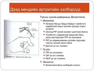 Дээд мөчдийн артритийн хэлбэрүүд
Товчны нүхний деформаци (Boutonniere)
 Механизм
 Латерал багцыг барьж байдаг тэнийлгэгч

шөрмөсний захын хэсгийн урагдал эсвэл
сулрана
 Эхлээд PIP үений синовит шалтгаан болно
 Тэнийлгэгч шөрмөсний хажуугийн багц
доош мултарснаас PIP үе нугаларна
 PIP үе шөрмөснөөсөө цүлхийж гарснаар
товчны нүхний шинж гарна
 Дистал үе хэт тэнийнэ
 Үр дүн
 PIP үе нугаларна
 DIP үе хэт тэнийнэ
 MCP үе хэт тэнийнэ

 Эмчилгээ
 Boutonniere бөгж хэлбэрийн сплинт

 