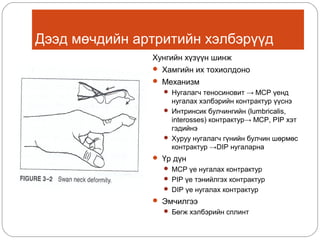Дээд мөчдийн артритийн хэлбэрүүд
Хунгийн хүзүүн шинж
 Хамгийн их тохиолдоно
 Механизм
 Нугалагч теносиновит → MCP үенд

нугалах хэлбэрийн контрактур үүснэ
 Интринсик булчингийн (lumbricalis,
interosses) контрактур→ MCP, PIP хэт
гэдийнэ
 Хуруу нугалагч гүнийн булчин шөрмөс
контрактур →DIP нугаларна
 Үр дүн
 MCP үе нугалах контрактур
 PIP үе тэнийлгэх контрактур
 DIP үе нугалах контрактур

 Эмчилгээ
 Бөгж хэлбэрийн сплинт

 