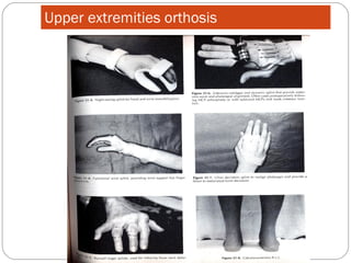 Upper extremities orthosis

 
