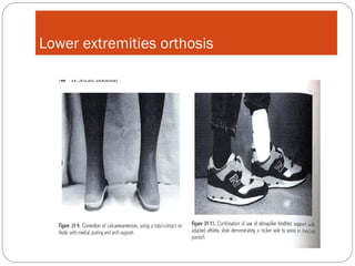 Lower extremities orthosis

 