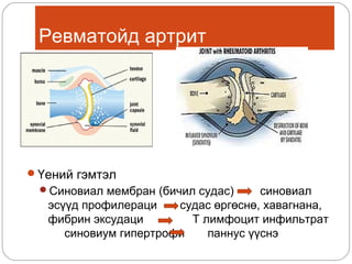 Ревматойд артрит

Үений гэмтэл
Синовиал мембран (бичил судас)

синовиал
эсүүд профилераци
судас өргөснө, хавагнана,
фибрин эксудаци
Т лимфоцит инфильтрат
синовиум гипертрофи
паннус үүснэ

 