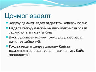 Цочмог өвдөлт
Хөлрүү дамжиж өвдөх өвдөлттэй хавсарч болно
Өвдөлт хөлрүү дамжих нь диск цүлхийсэн эсвэл

радикулопати гэсэн үг биш
Диск цүлхийсэн ихэнхи тохиолдолд мэс засал
эмчилгээ хийдэггүй.
Гэхдээ өвдөлт хөлрүү дамжиж байгаа
тохиолдолд эдгэрэлт удаан, тавилан муу байх
магадлалтай

 