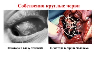 Нематода в глазу человека Нематода в сердце человека
Собственно круглые черви
 