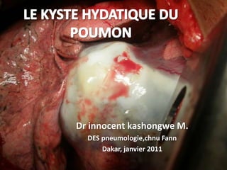Dr innocent kashongwe M.
  DES pneumologie,chnu Fann
      Dakar, janvier 2011
 