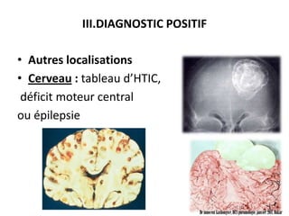 III.DIAGNOSTIC POSITIF

• Autres localisations
• Cerveau : tableau d’HTIC,
 déficit moteur central
ou épilepsie




                                Dr innocent kashongwe, DES pneumologie, janvier 2011, Dakar
 