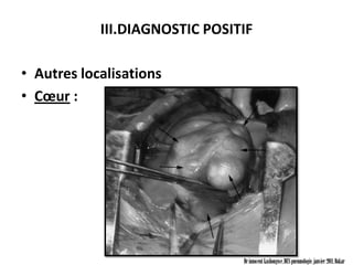 III.DIAGNOSTIC POSITIF

• Autres localisations
• Cœur :




                                Dr innocent kashongwe, DES pneumologie, janvier 2011, Dakar
 