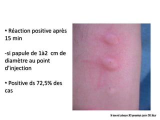 • Réaction positive après
15 min

-si papule de 1à2 cm de
diamètre au point
d’injection

• Positive ds 72,5% des
cas


                            Dr innocent kashongwe, DES pneumologie, janvier 2011, Dakar
 