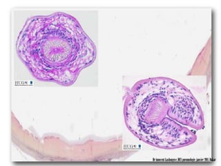 3.1.2.Examens paracliniques
c. anatomopathologie
• Possible en cas d’analyse d’une pièce
   opératoire

• Macroscopie: permet de voir l’hydatide
  entourée de son adventice

• Microscopie: permet de visualiser les
  éléments constitutifs de l’hydatide

                                   Dr innocent kashongwe, DES pneumologie, janvier 2011, Dakar
 