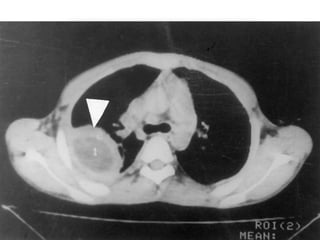 • Stade II , retrouvé ds 11,2% des cas,
  Fissuration, hémoptysie, :
Ménisque gazeux situé au pole supérieur de
  l’opacité entre la paroi externe du kyste et la
  paroi interne du périkyste.
Image de pneumokyste

Évolution: surinfection espace périkystique
 