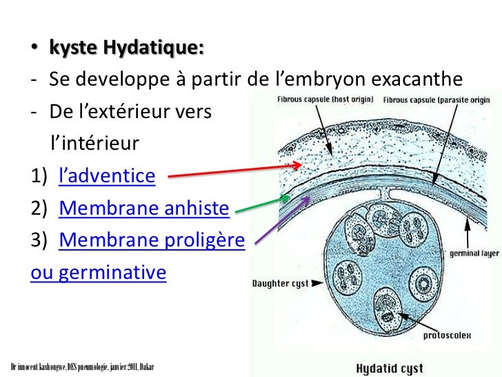 Le Kyste Hydatique Du Poumon Le Kyste Hydatique Du Poumon
