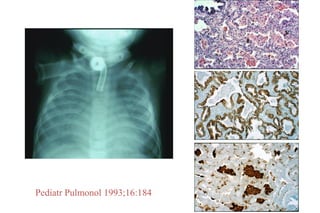 Pediatr Pulmonol 1993;16:184
 