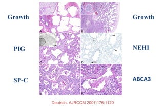 Growth
PIG
SP-C
NEHI
Growth
ABCA3
Deutsch. AJRCCM 2007;176:1120
 
