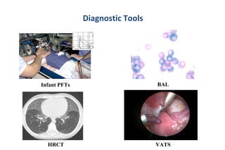 Diagnostic Tools
Infant PFTs
HRCT VATS
BAL
 