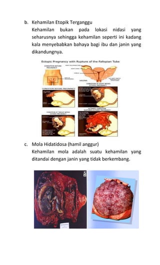 b. Kehamilan Etopik Terganggu
Kehamilan bukan pada lokasi nidasi yang
seharusnya sehingga kehamilan seperti ini kadang
kala menyebabkan bahaya bagi ibu dan janin yang
dikandungnya.
c. Mola Hidatidosa (hamil anggur)
Kehamilan mola adalah suatu kehamilan yang
ditandai dengan janin yang tidak berkembang.
 