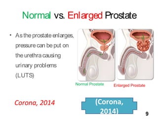 Normal vs. Enlarged Prostate
• Astheprostateenlarges,
pressurecan beput on
theurethracausing
urinary problems
(LUTS)
Coron...