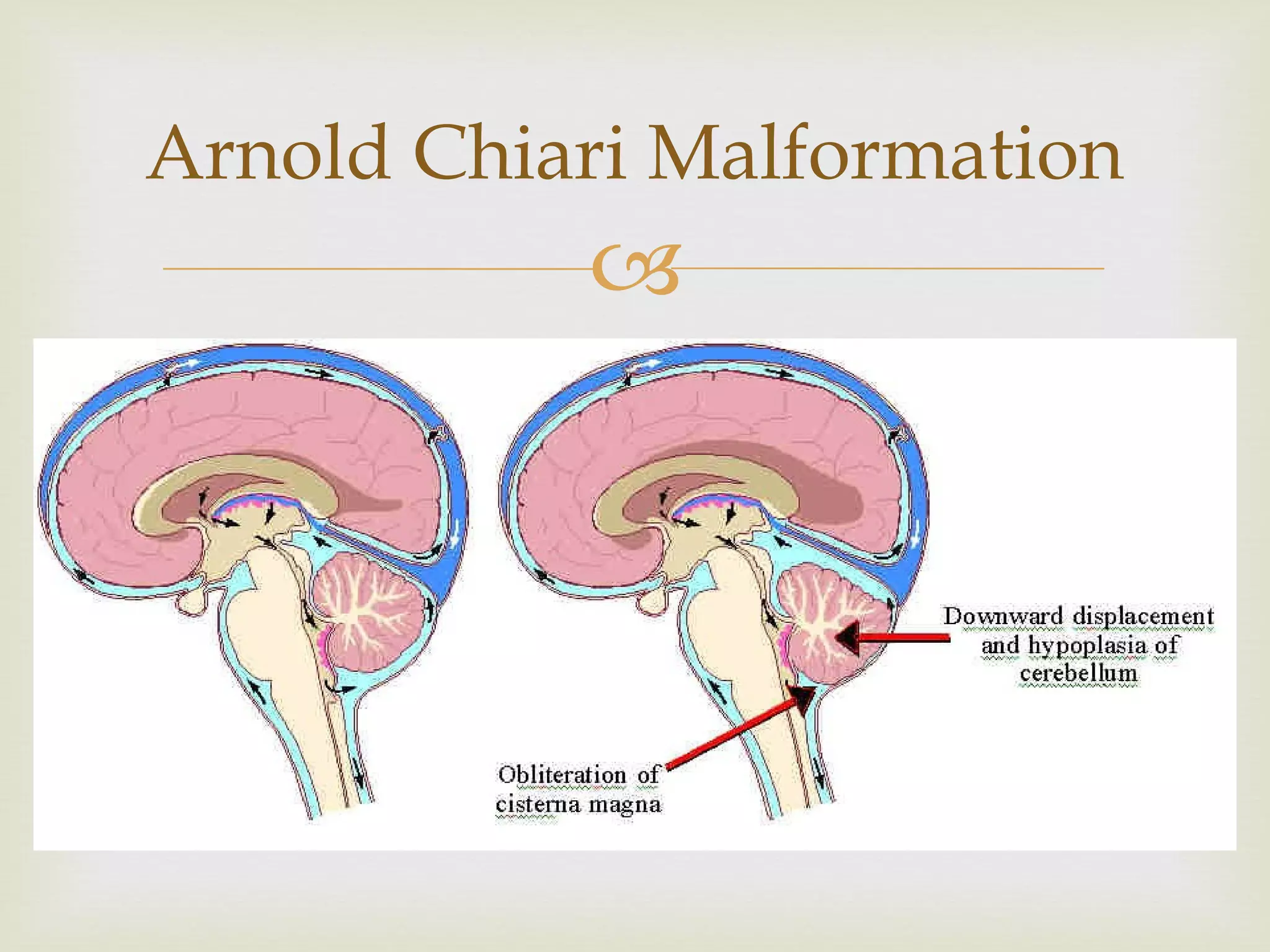 Arnold Chiari Malformation 