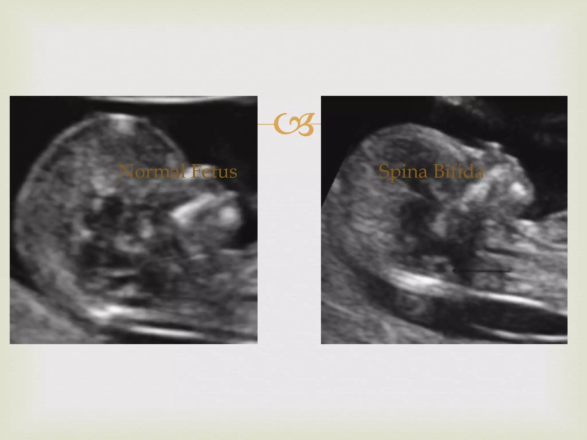 Normal Fetus Spina Bifida 