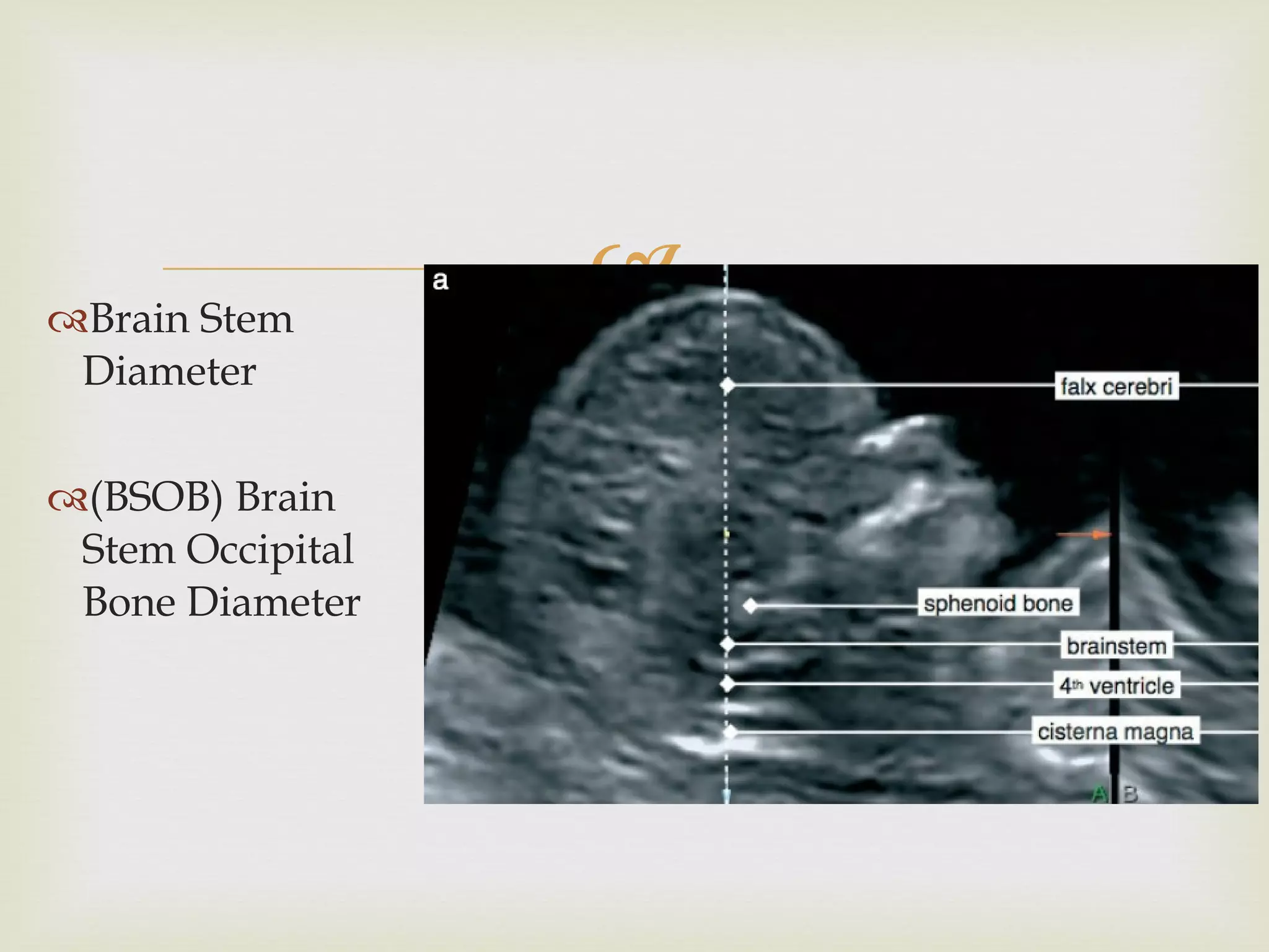 Brain Stem Diameter (BSOB) Brain Stem Occipital Bone Diameter 