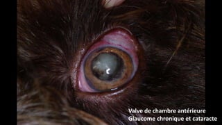 Valve de chambre antérieure
Glaucome chronique et cataracte

 