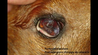 Perforation oculaire
Post-opératoire chirurgie de cataracte

 