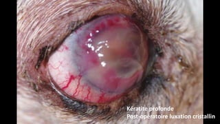 Kératite profonde
Post-opératoire luxation cristallin

 
