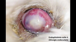 Endophtalmie suite à
chirurgie endoculaire

 