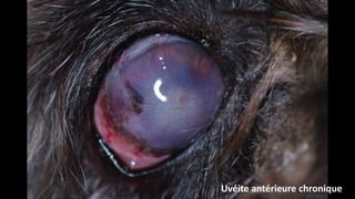 Uvéite antérieure chronique

 