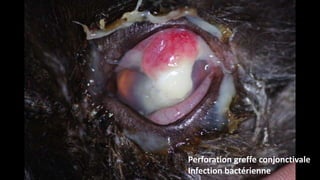 Perforation greffe conjonctivale
Infection bactérienne

 