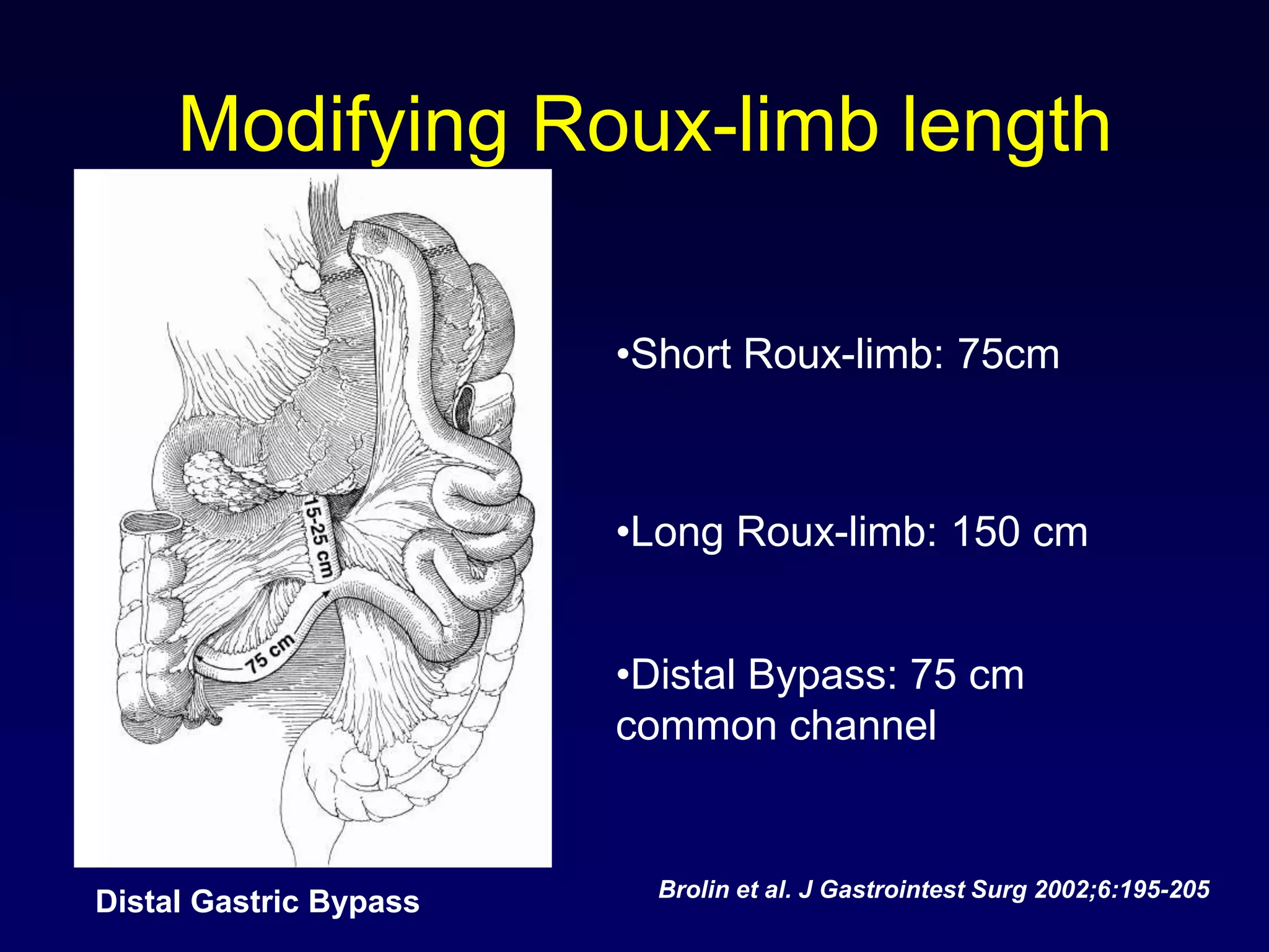 Modifying Roux-limb lengthShort Roux-limb: 75cm